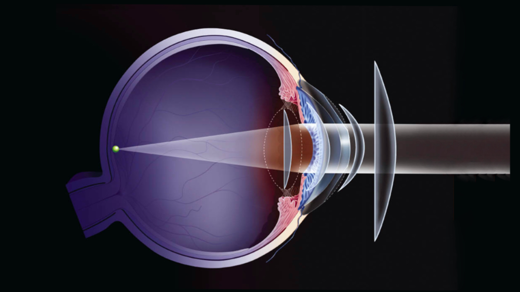 The refraction and retinoscopy ,part I Geometrical Optics